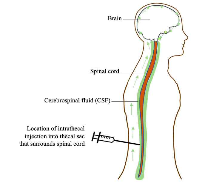 Snapshot What Are Intrathecal Injections National Ataxia Foundation